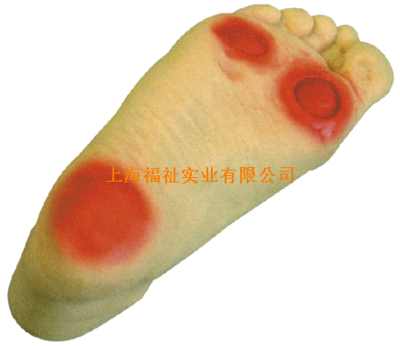 高级糖尿病足护理模型